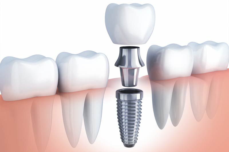 Implants Dentist in Greenwood