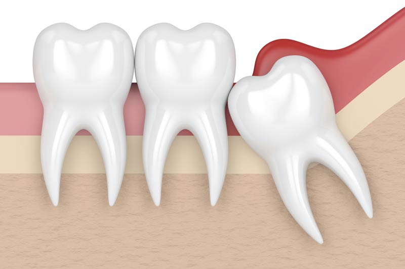 Wisdom Tooth Removal in Greenwood